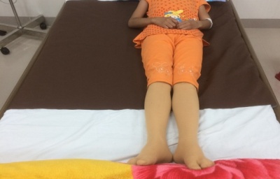 Hen phế quản nặng điều trị ổn định tại Khoa Hồi sức tích cực bệnh viện Sản - Nhi tỉnh Quảng Ngãi.
